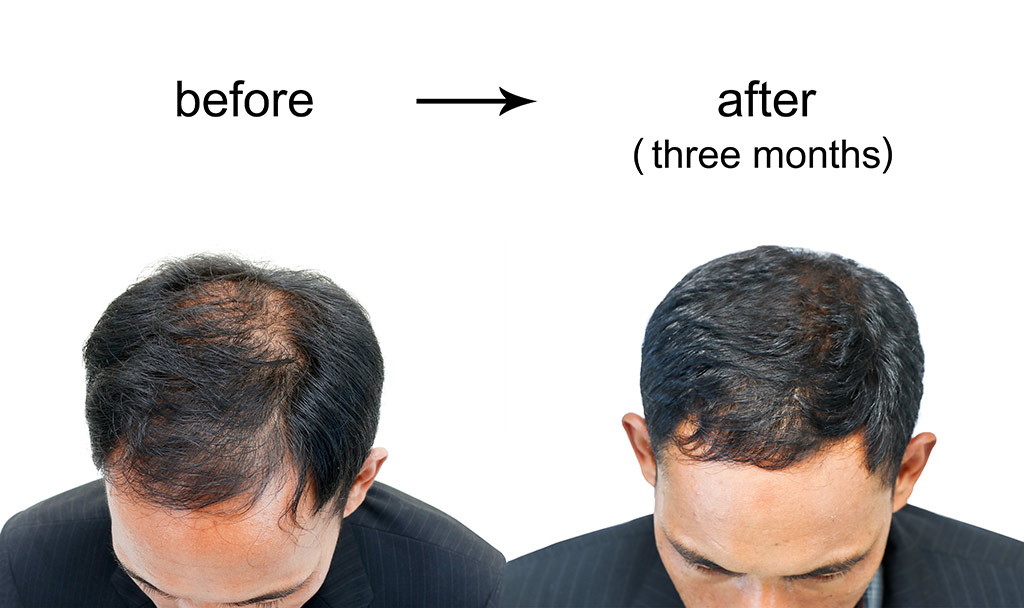 Best hair transplant clinics in Turkey Best hair transplant clinics in Turkey