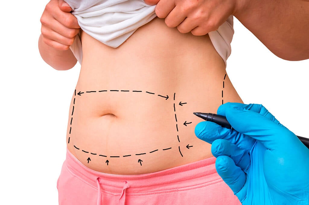 The best places for liposuction abroad in 2020 The best places for liposuction abroad in 2020