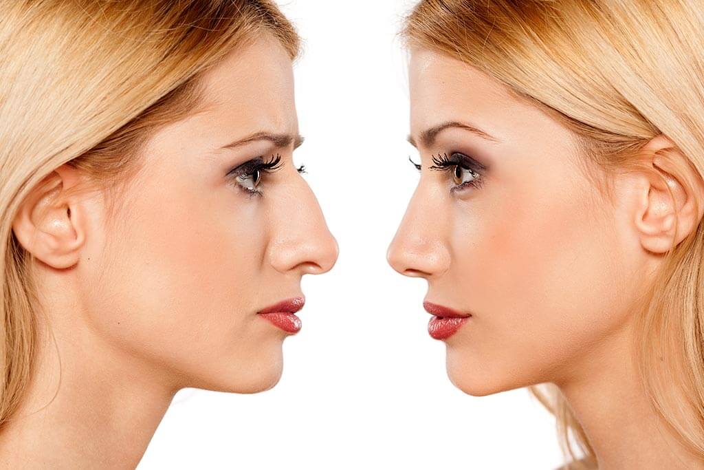 Rhinoplasty (nose job) clinic in Turkey Rhinoplasty (nose job) clinic in Turkey