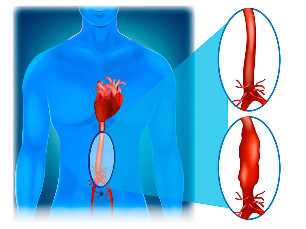 Aortic aneurysm Aortic aneurysm