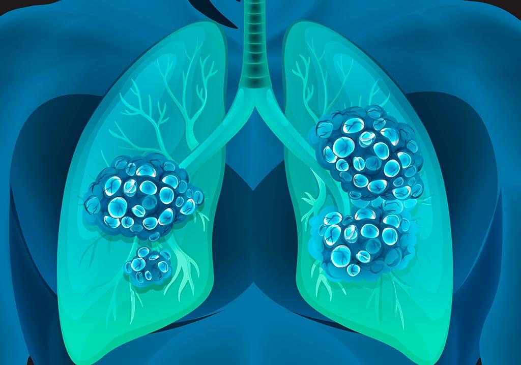 Stages of Lung Cancer Stages of Lung Cancer