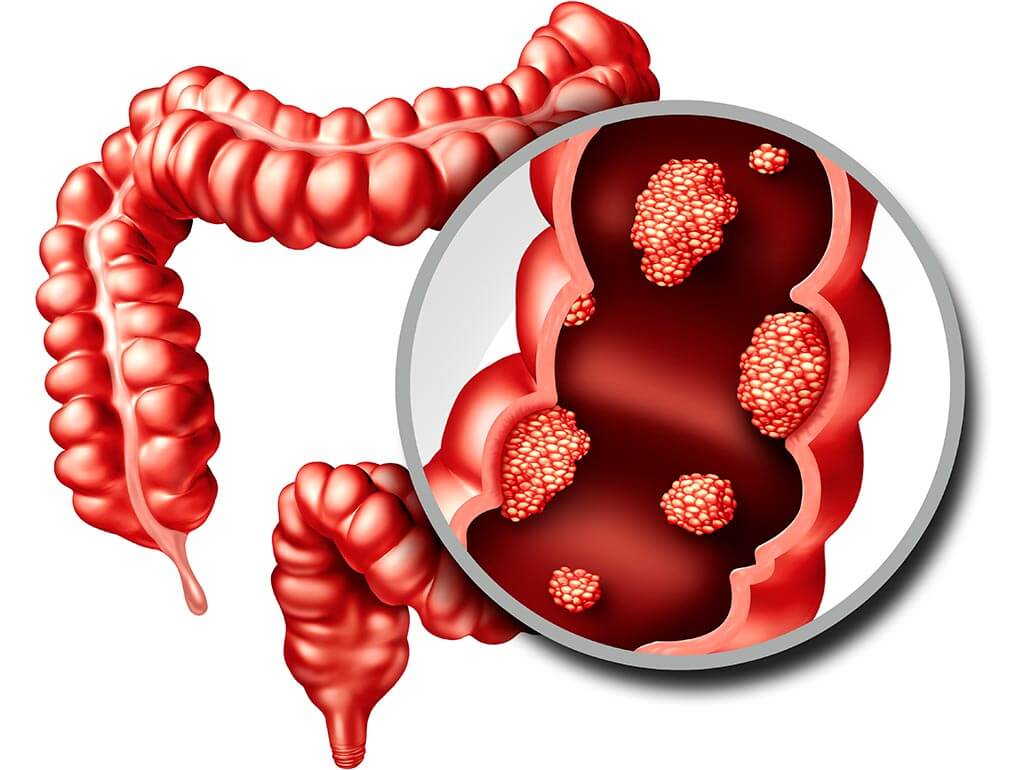 Bowel Cancer Bowel Cancer