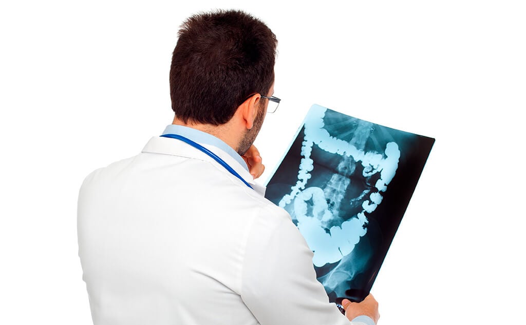 Bowel cancer stages Bowel cancer stages