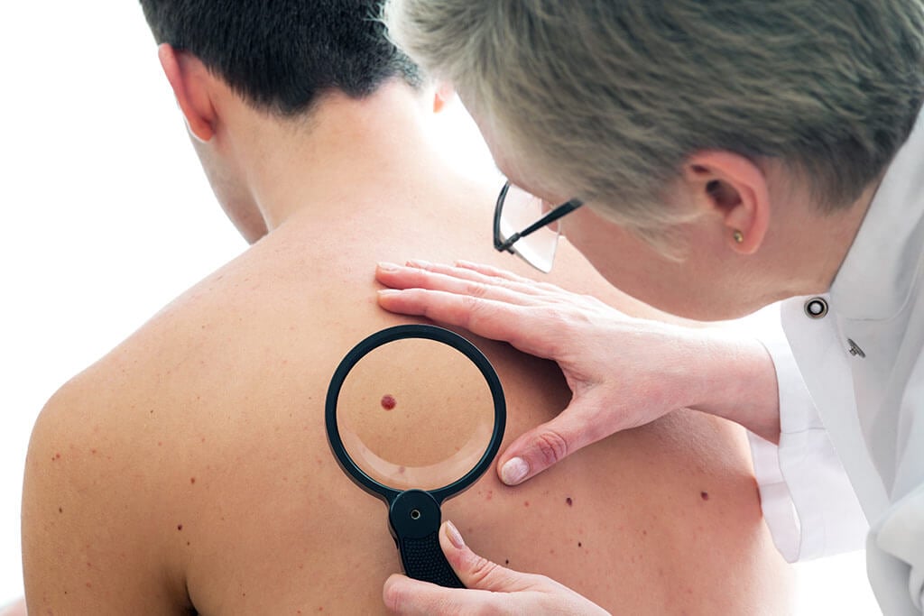 Treatment of melanoma abroad Treatment of melanoma abroad