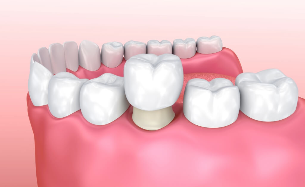 Installation of dental crowns in Turkey Installation of dental crowns in Turkey