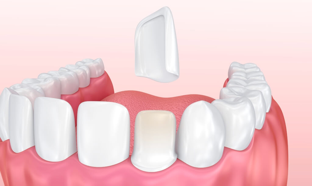 Installation of veneers in Turkey Installation of veneers in Turkey