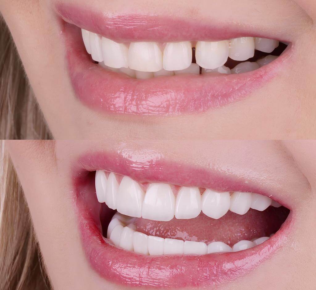 Installation of veneers in Turkey Installation of veneers in Turkey