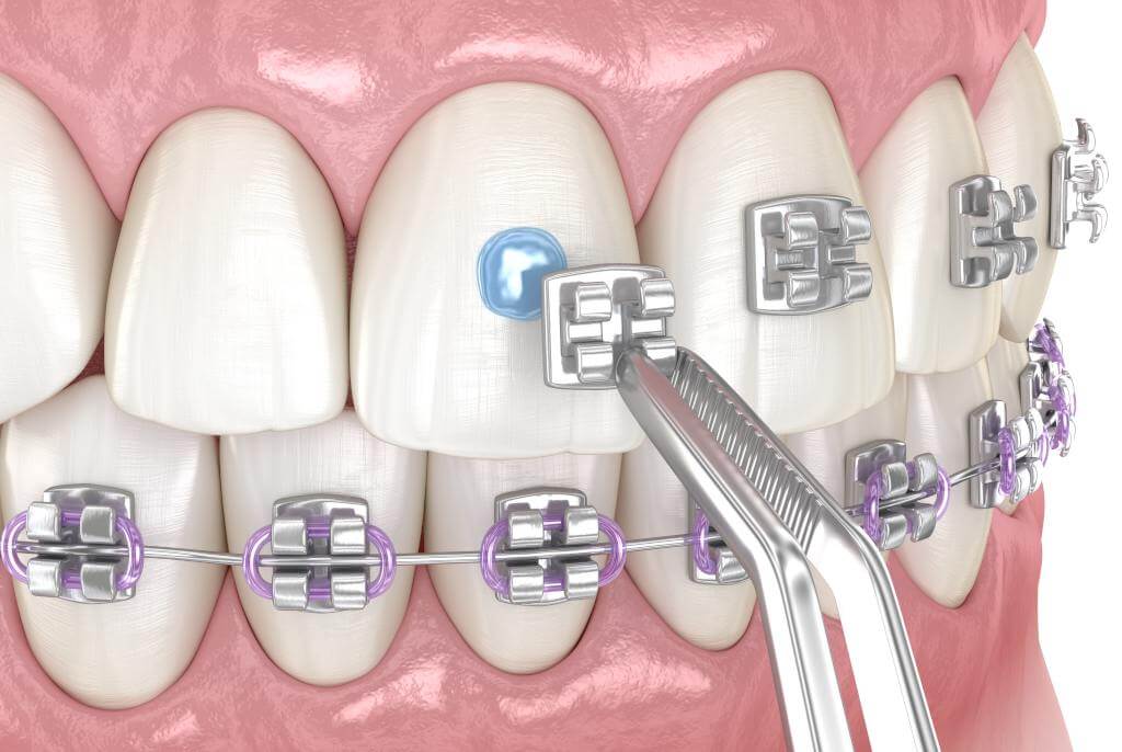 Installing braces in Turkey Installing braces in Turkey