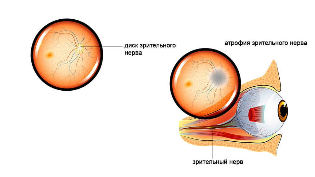 Атрофия зрительного нерва