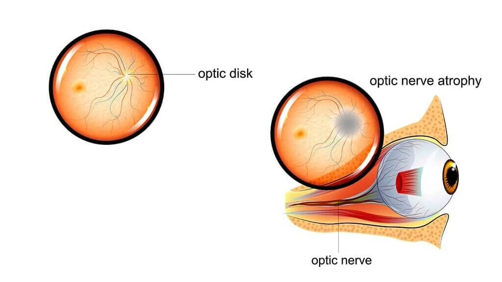 Optic atrophy