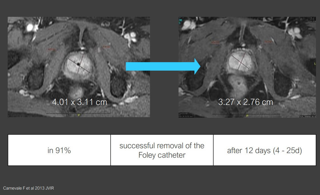 Acute urinary retention