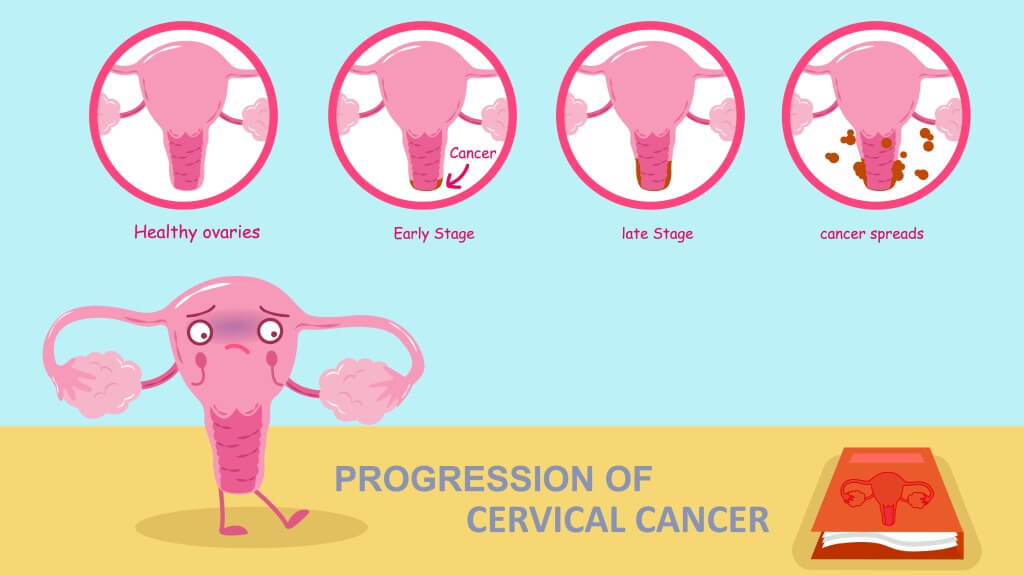 Stage of cervical cancer