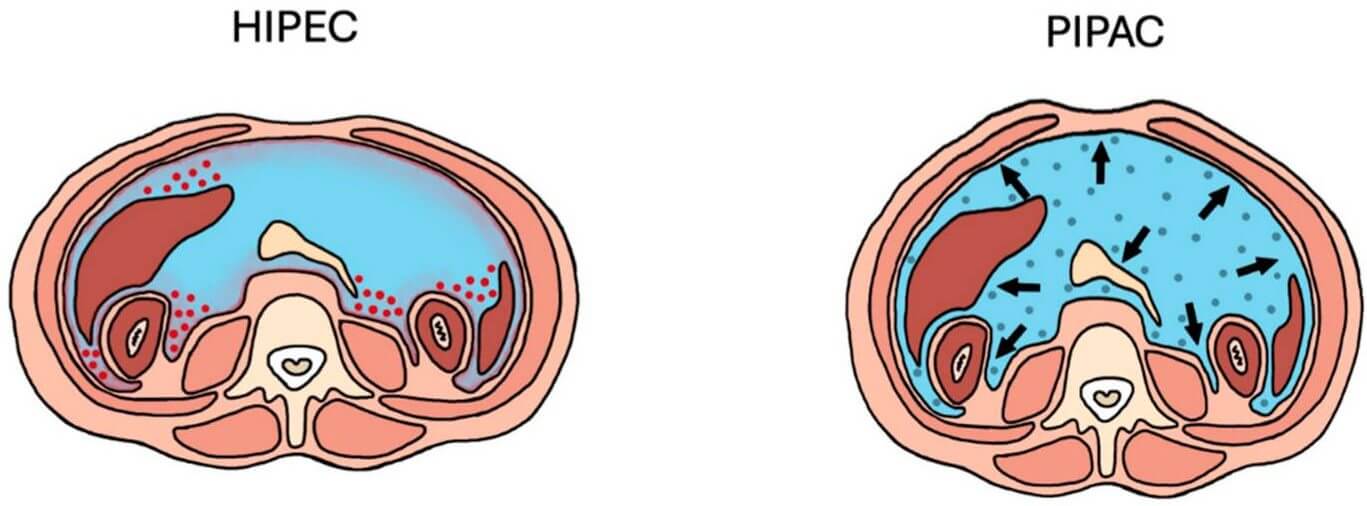 Прогресс в области хирургического лечения перитонеального канцероматоза на фоне рака желудка: техники HIPEC и PIPAC