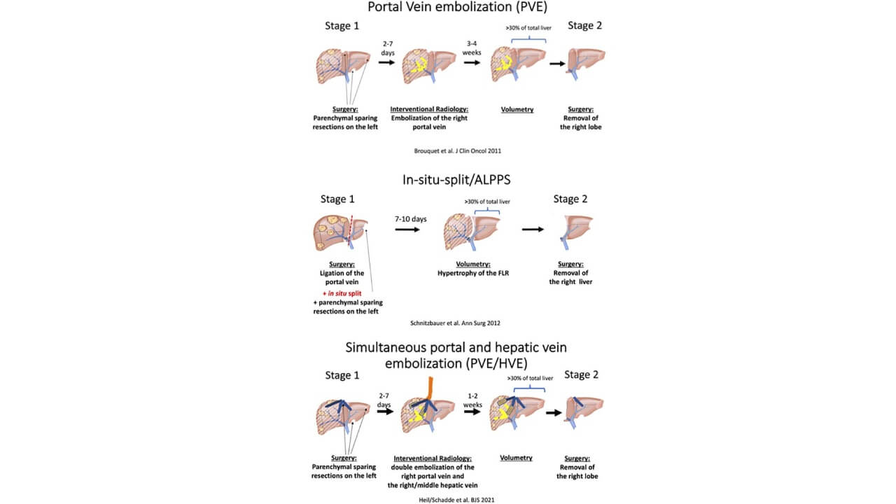 Portal vein embolization procedures diagram showing PVE, ALPPS, and simultaneous PVE/HVE techniques for liver surgery