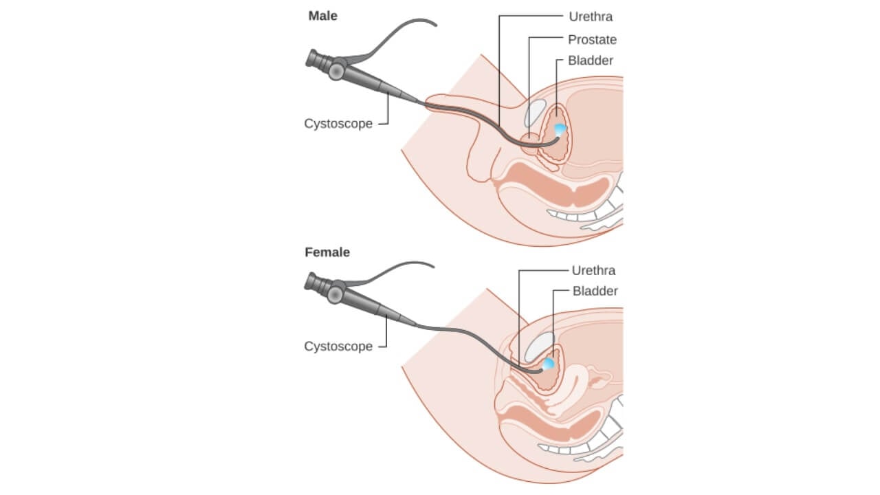Цистоскопия