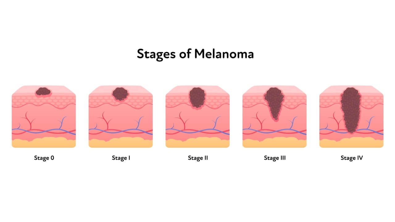 Стадии меланомы
