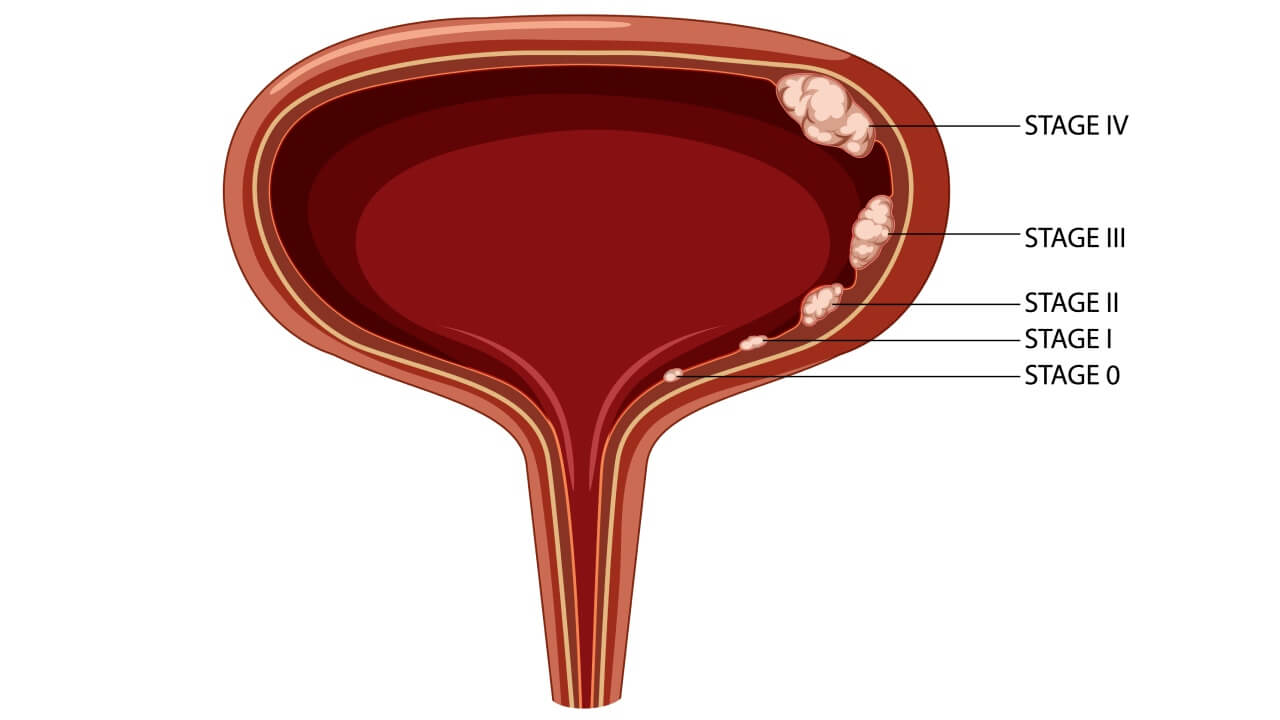 Stages of bladder cancer