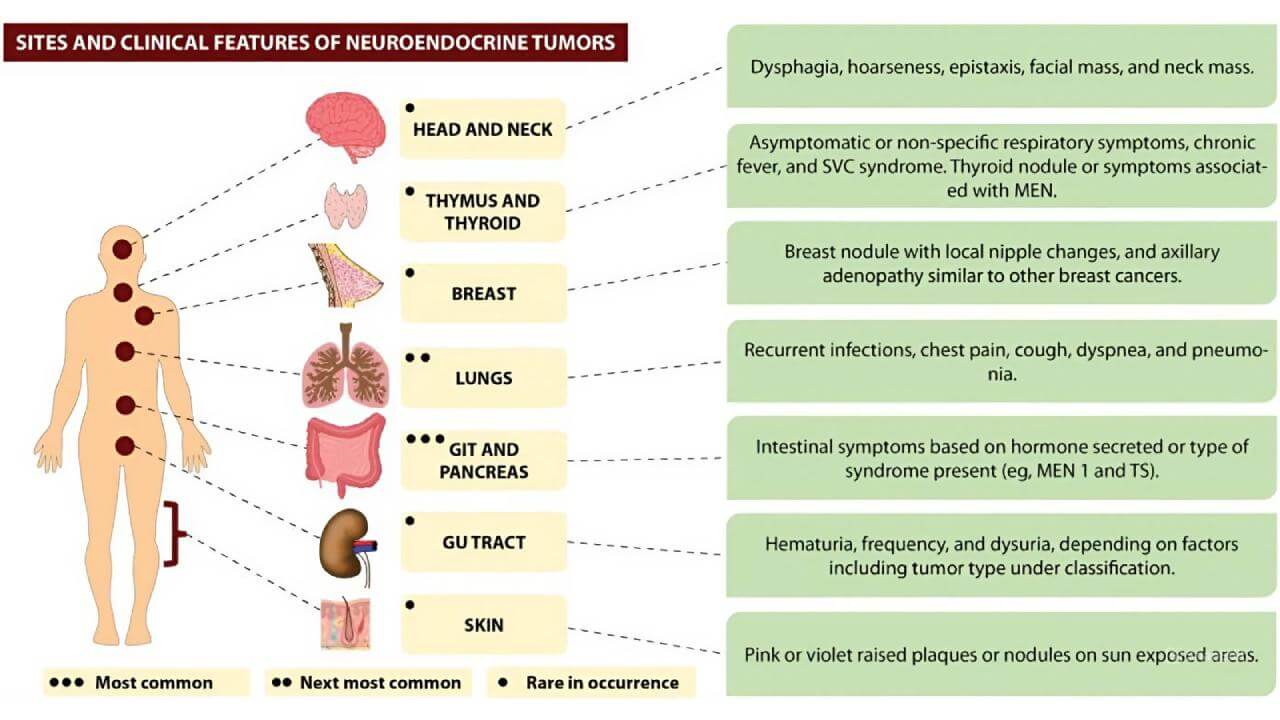 Common locations and clinical features of neuroendocrine tumors