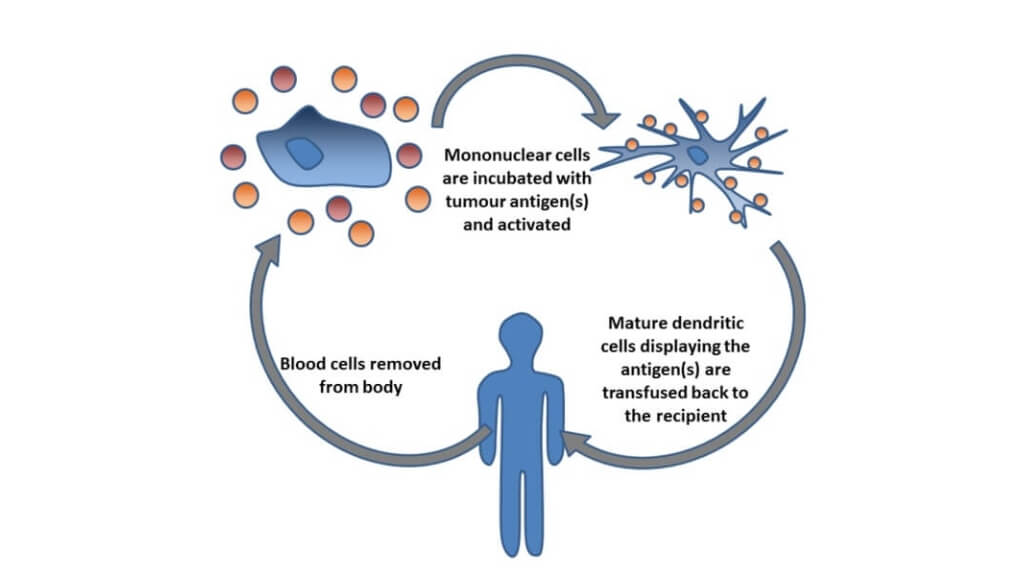 Dendritic cell therapy process diagram showing blood cell extraction, antigen incubation, and transfusion from Wikimedia Commons