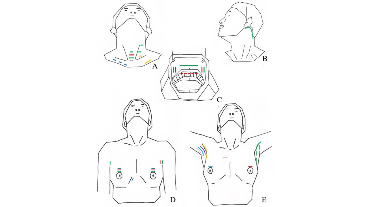 Design of skin incisions in various types of robotic/endoscopic thyroidectomies