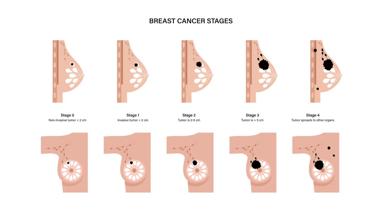 Breast cancer stages