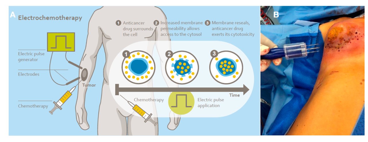Mechanism of reversible electroporation with chemotherapy, also known as electrochemotherapy