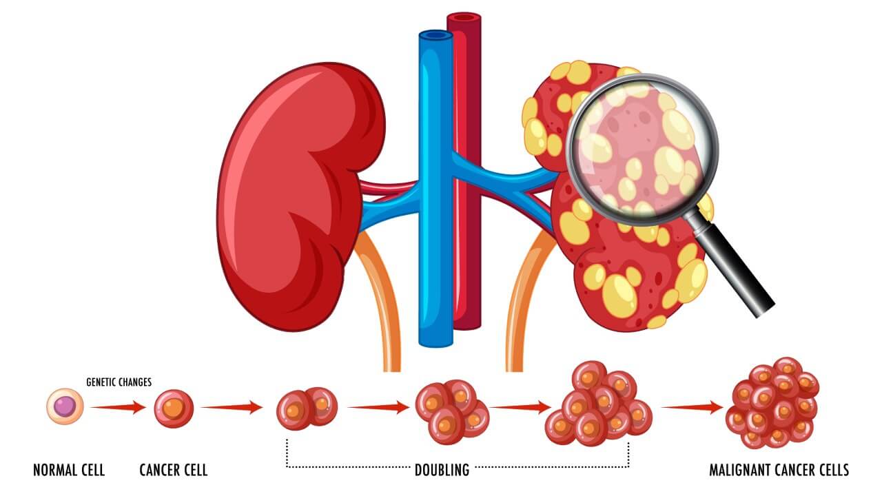 Cancer development process