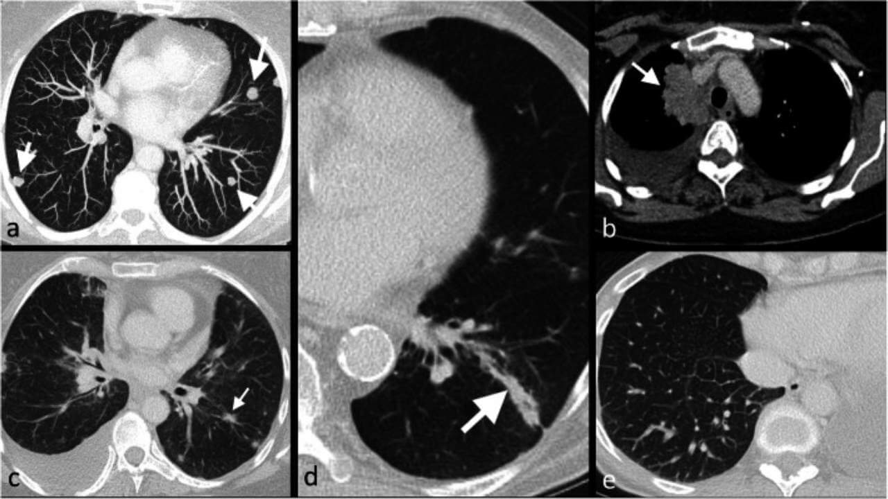 Morphological appearances of lung metastases