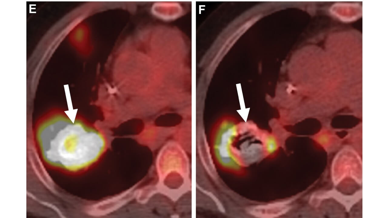 E) Pretreatment PET/CT scan shows hypermetabolic lung metastases (arrow). (F) PET/CT scan after transarterial chemoembolization shows partial metabolic response(arrow)