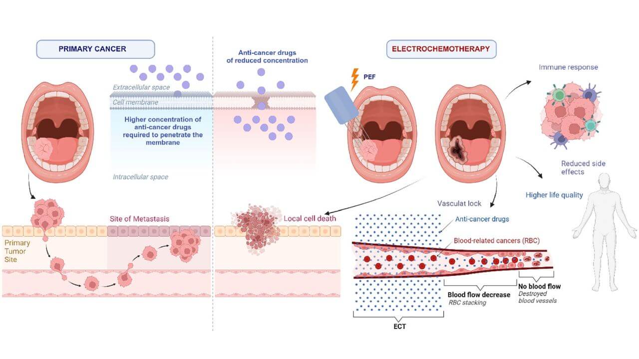 Effects of electrochemotherapy in head and neck cancers