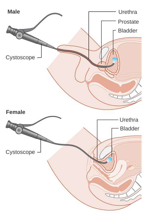 Файл:Diagram showing a cystoscopy for a man and a woman CRUK 064.svg